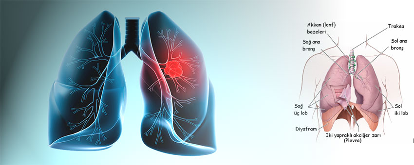 Akciğer kanseri nedir, kanserin belirtileri, akciğer kanseri korunma ve tedavi yöntemleri nelerdir